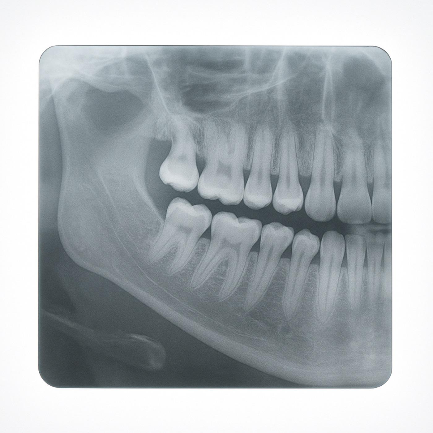 Wisdom Teeth Extraction